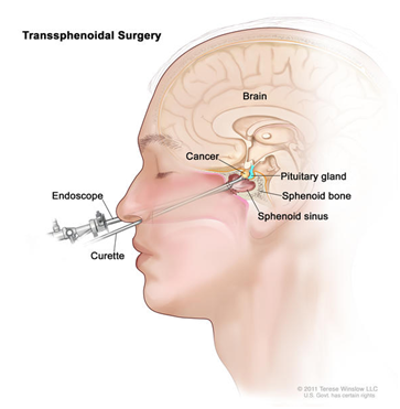 Pituitary tumors