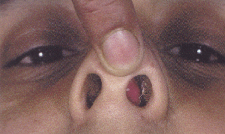 Deviated nasal septum
